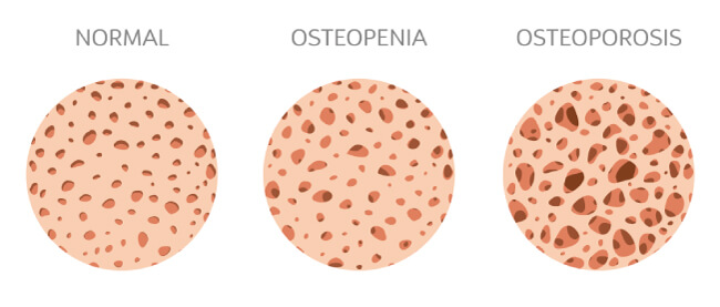 Esquema de densitometría ósea DXA
